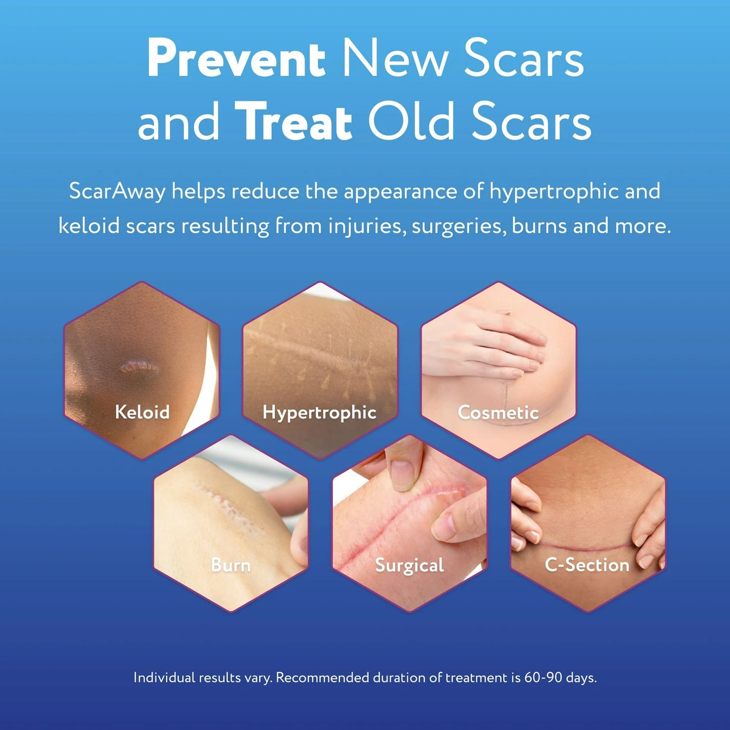 ScarAway Advanced Skincare 100 Percent Medical Grade Silicone Scar Gel, 3 Month Supply