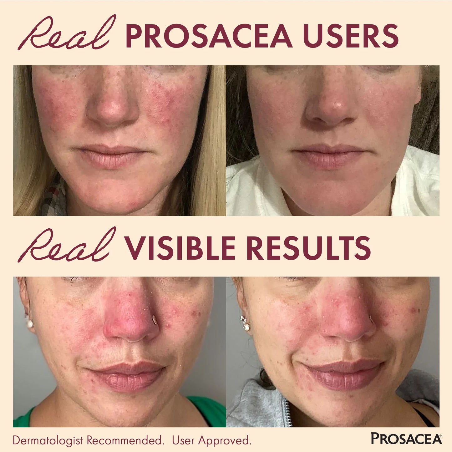 Prosacea Rosacea Gel, Heals Rosacea Symptoms of Redness, Pimples and Irritation, 0.75 oz